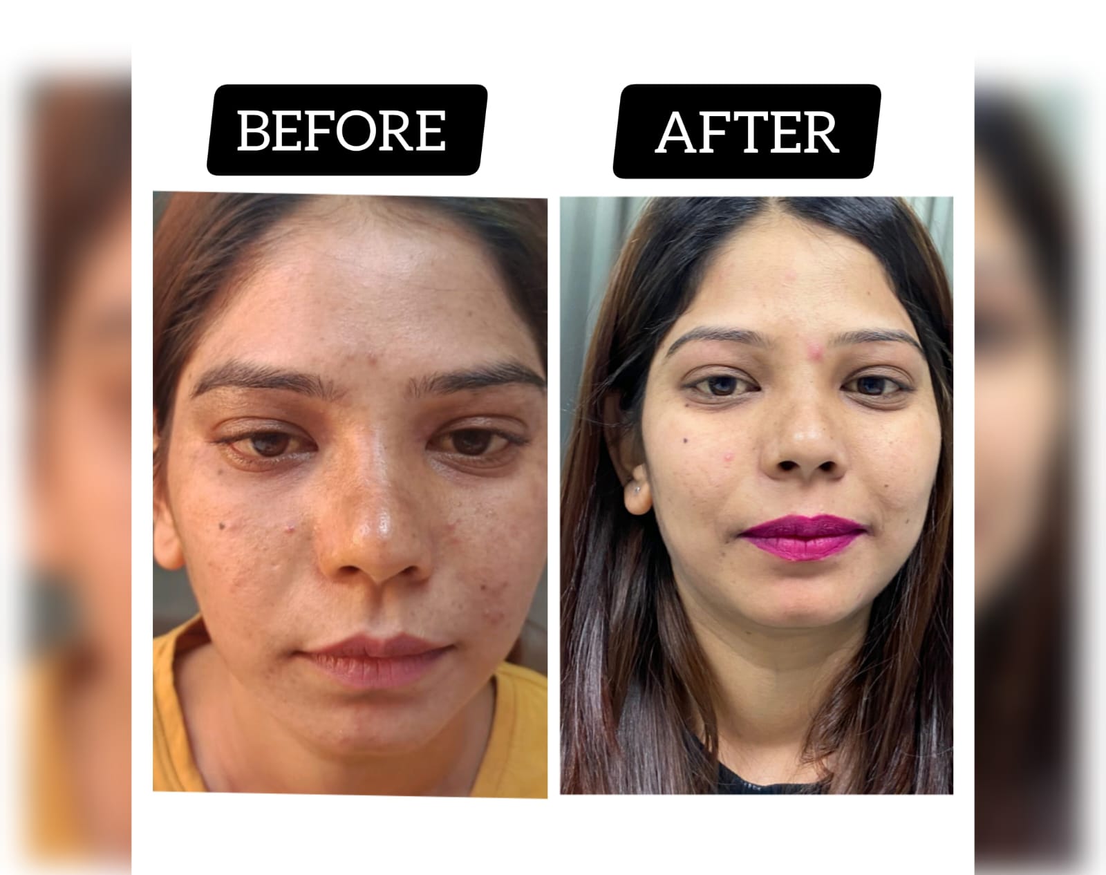 Pigmentation treatment